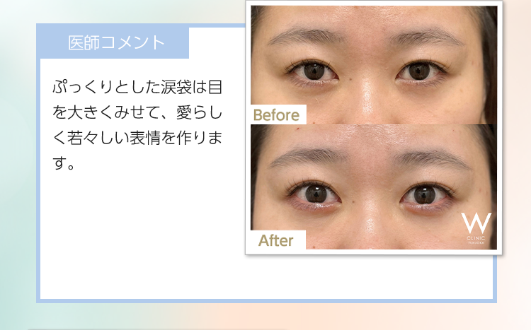 【20代女性 - 涙袋形成】医師コメント：皮下にヒアルロン酸を注入し、涙袋の形を形成しました。