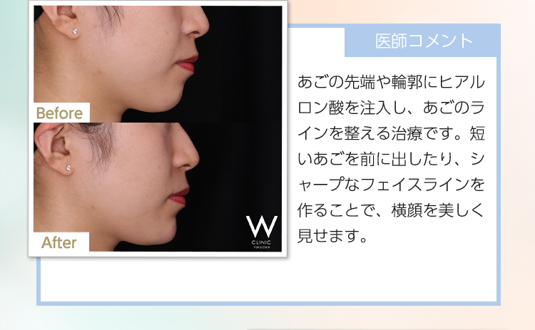 【30代女性 - 鼻筋形成】医師コメント：鼻の高さを出しながら、自然な美しさを感じられる横顔になるように調整しました。