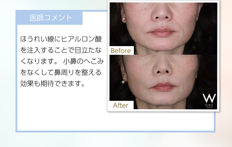 【20代女性 - ほうれい線改善】医師コメント：鼻の高さを出しながら、自然な美しさを感じられる横顔になるように調整しました。