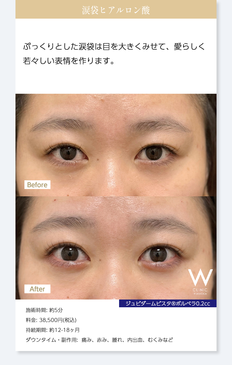 【涙袋ヒアルロン酸】ぷっくりとした涙袋は目を大きくみせて、愛らしく若々しい表情を作ります。｜ジュビダームビスタ®︎ボルベラ0.2cc｜施術時間: 約5分/料金: 38,500円(税込) ※1本単位なので/持続期間: 約12-18ヶ月/ダウンタイム・副作用:  痛み、赤み、腫れ、内出血、むくみなど