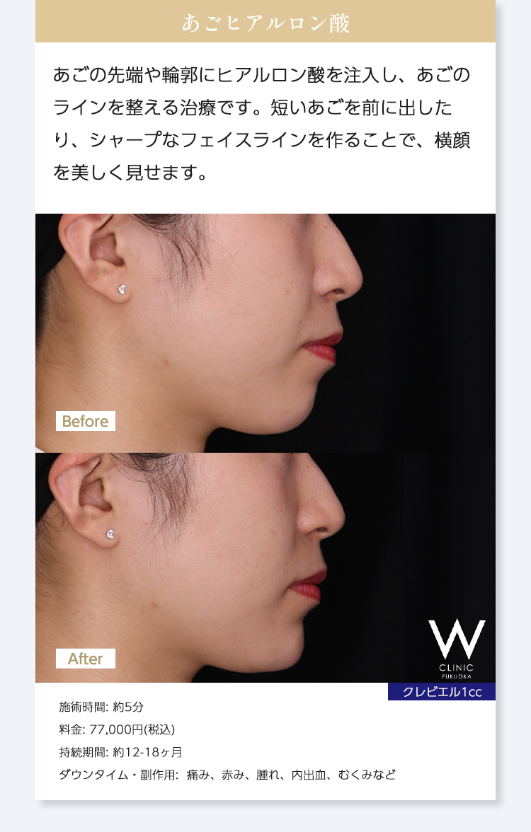 【あごヒアルロン酸】あごの先端や輪郭にヒアルロン酸を注入し、あごのラインを整える治療です。短いあごを前に出したり、シャープなフェイスラインを作ることで、横顔を美しく見せます。｜クレビエル1cc｜施術時間: 約5分/料金: 77,000円(税込) /持続期間: 約12-18ヶ月/ダウンタイム・副作用:  痛み、赤み、腫れ、内出血、むくみなど