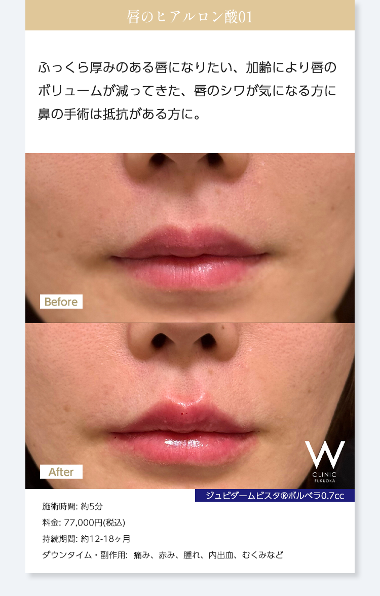 【唇のヒアルロン酸01】ふっくら厚みのある唇になりたい、加齢により唇のボリュームが減ってきた、唇のシワが気になる方に鼻の手術は抵抗がある方に。｜ジュビダームビスタ®︎ボルベラ0.7cc｜施術時間: 約5分/料金: 77,000円(税込) ※1本単位なので/持続期間: 約12-18ヶ月/ダウンタイム・副作用:  痛み、赤み、腫れ、内出血、むくみなど