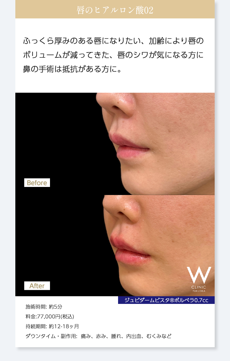 【唇のヒアルロン酸02】ふっくら厚みのある唇になりたい、加齢により唇のボリュームが減ってきた、唇のシワが気になる方に鼻の手術は抵抗がある方に。｜ジュビダームビスタ®︎ボルベラ0.7cc｜施術時間: 約5分/料金:77,000円(税込) ※1本単位なので/持続期間: 約12-18ヶ月/ダウンタイム・副作用:  痛み、赤み、腫れ、内出血、むくみなど