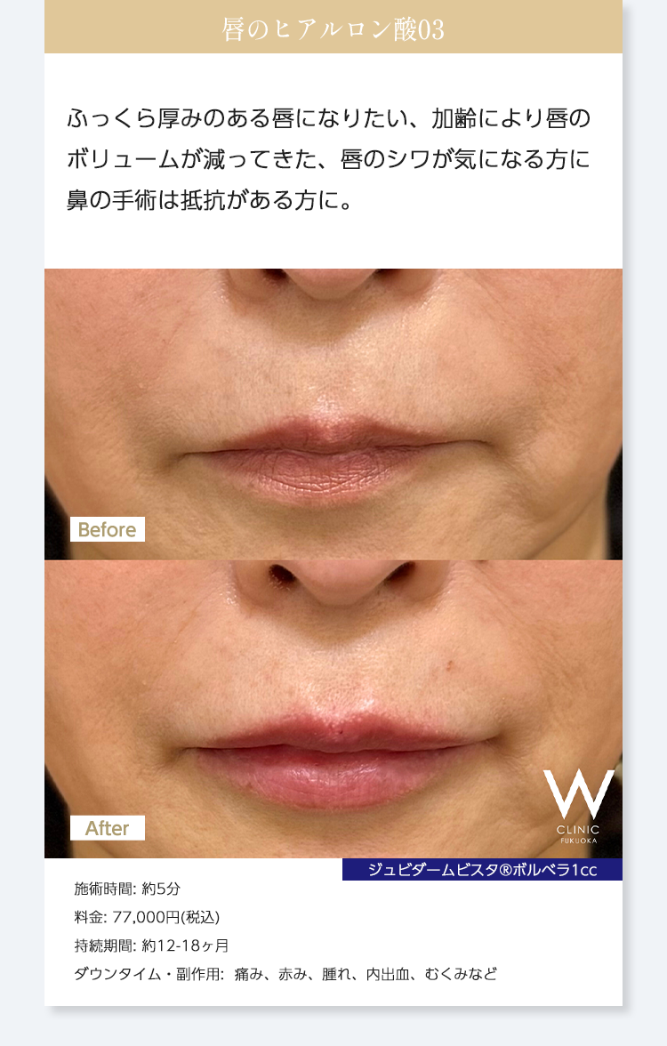 【唇のヒアルロン酸03】ふっくら厚みのある唇になりたい、加齢により唇のボリュームが減ってきた、唇のシワが気になる方に鼻の手術は抵抗がある方に。｜ジュビダームビスタ®︎ボルベラ1cc｜施術時間: 約5分/料金: 77,000円(税込)/持続期間: 約12-18ヶ月/ダウンタイム・副作用:  痛み、赤み、腫れ、内出血、むくみなど