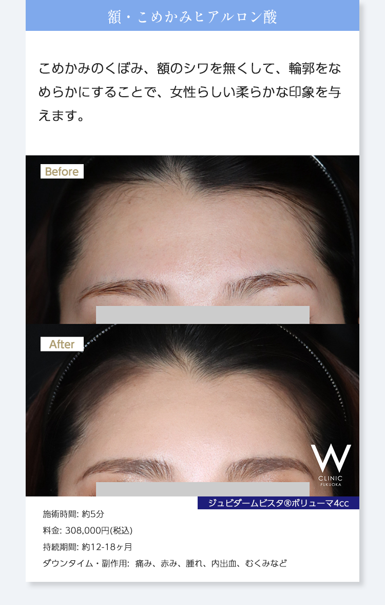 【額・こめかみヒアルロン酸】こめかみのくぼみ、額のシワを無くして、輪郭をなめらかにすることで、女性らしい柔らかな印象を与えます。｜ジュビダームビスタ®︎ボリューマ4cc｜施術時間: 約5分/料金: 308,000円(税込)/持続期間: 約12-18ヶ月/ダウンタイム・副作用:  痛み、赤み、腫れ、内出血、むくみなど