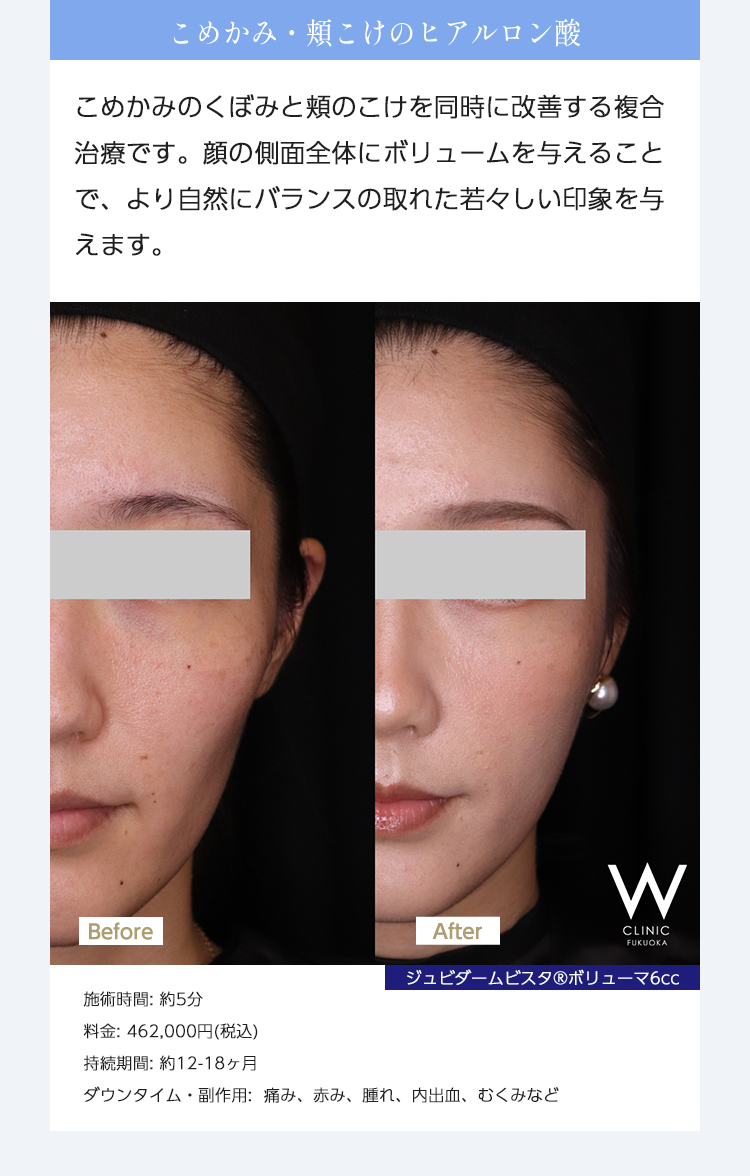 【こめかみ・頬こけのヒアルロン酸】こめかみのくぼみと頬のこけを同時に改善する複合治療です。顔の側面全体にボリュームを与えることで、より自然にバランスの取れた若々しい印象を与えます。｜ジュビダームビスタ®︎ボリューマ6cc｜施術時間: 約5分/料金: 462,000円(税込)/持続期間: 約12-18ヶ月/ダウンタイム・副作用:  痛み、赤み、腫れ、内出血、むくみなど