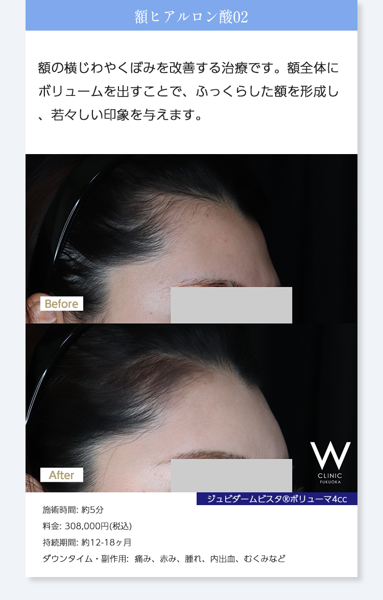 【額ヒアルロン酸02】額の横じわやくぼみを改善する治療です。額全体にボリュームを出すことで、ふっくらした額を形成し、若々しい印象を与えます。｜ジュビダームビスタ®︎ボリューマ4cc｜施術時間: 約5分/料金: 308,000円(税込)/持続期間: 約12-18ヶ月/ダウンタイム・副作用:  痛み、赤み、腫れ、内出血、むくみなど