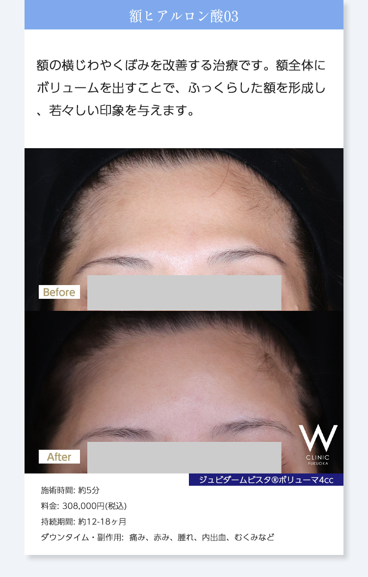 【額ヒアルロン酸03】額の横じわやくぼみを改善する治療です。額全体にボリュームを出すことで、ふっくらした額を形成し、若々しい印象を与えます。｜ジュビダームビスタ®︎ボリューマ4cc｜施術時間: 約5分/料金: 308,000円(税込)/持続期間: 約12-18ヶ月/ダウンタイム・副作用:  痛み、赤み、腫れ、内出血、むくみなど