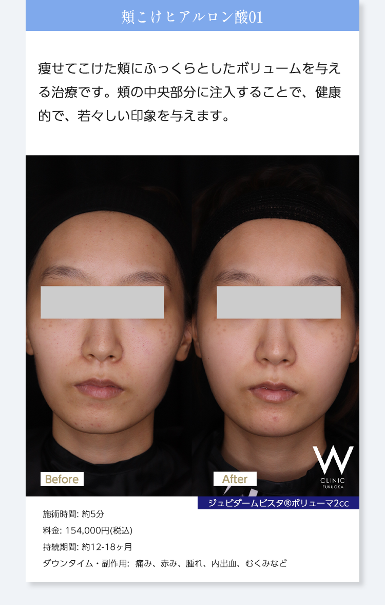 【頬こけヒアルロン酸01】痩せてこけた頬にふっくらとしたボリュームを与える治療です。頬の中央部分に注入することで、健康的で、若々しい印象を与えます。｜ジュビダームビスタ®︎ボリューマ2cc｜施術時間: 約5分/料金: 154,000円(税込)/持続期間: 約12-18ヶ月/ダウンタイム・副作用:  痛み、赤み、腫れ、内出血、むくみなど