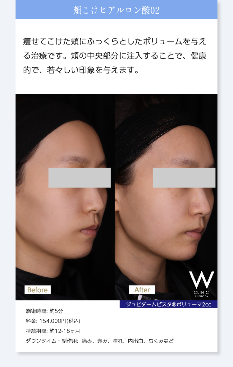 【頬こけヒアルロン酸02】痩せてこけた頬にふっくらとしたボリュームを与える治療です。頬の中央部分に注入することで、健康的で、若々しい印象を与えます。｜ジュビダームビスタ®︎ボリューマ2cc｜施術時間: 約5分/料金: 154,000円(税込)/持続期間: 約12-18ヶ月/ダウンタイム・副作用:  痛み、赤み、腫れ、内出血、むくみなど