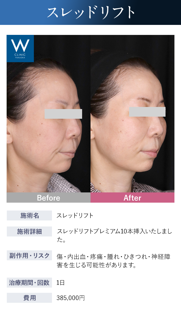 【スレッドリフト】施術詳細：スレッドリフトプレミアム10本挿入いたしました。｜副作用・リスク：傷・内出血・疼痛・腫れ・ひきつれ・神経障害を生じる可能性があります。｜治療期間・回数：1日｜費用：385,000円