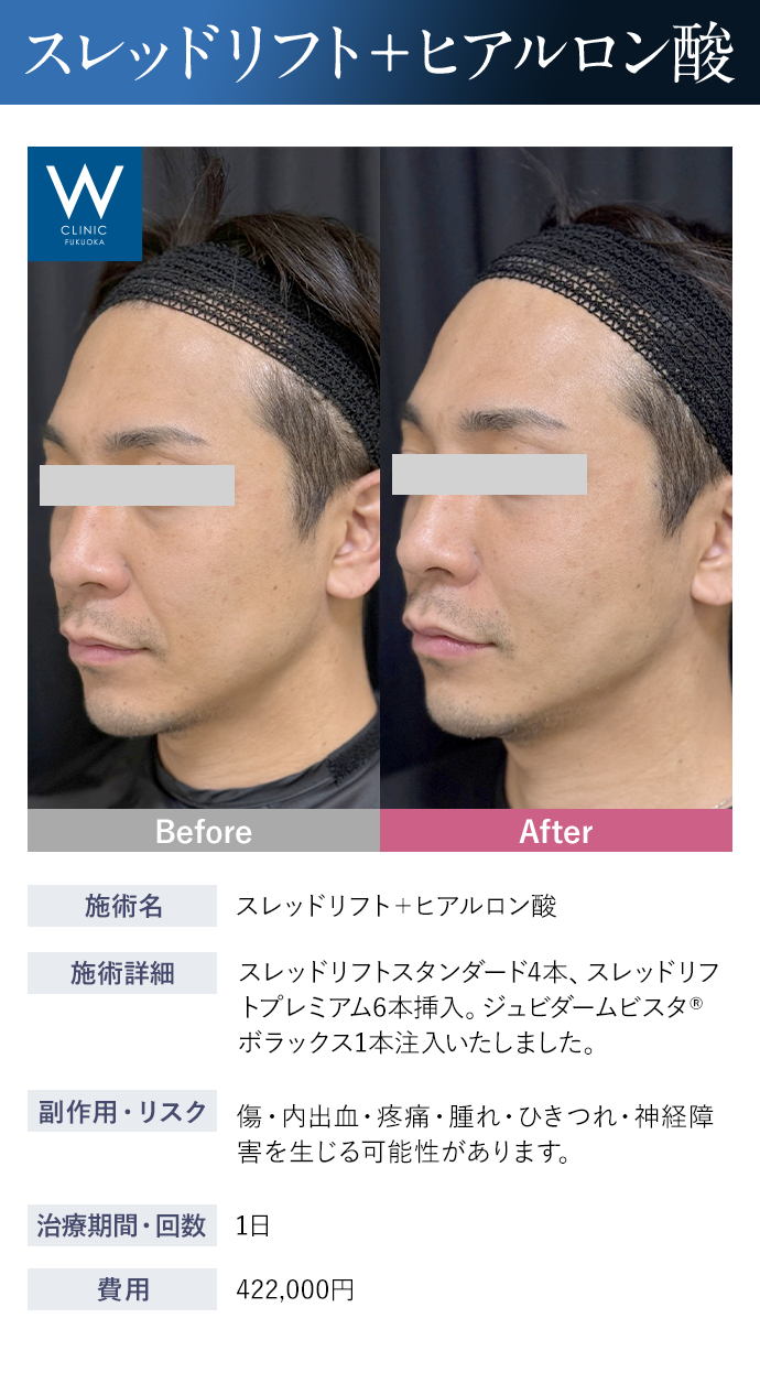 【スレッドリフト+ヒアルロン酸】施術詳細：スレッドリフトスタンダード4本、スレッドリフトプレミアム6本挿入。ジュビダームビスタ®ボラックス1本注入いたしました。｜副作用・リスク：傷・内出血・疼痛・腫れ・ひきつれ・神経障害を生じる可能性があります。｜治療期間・回数：1日｜費用：422,000円