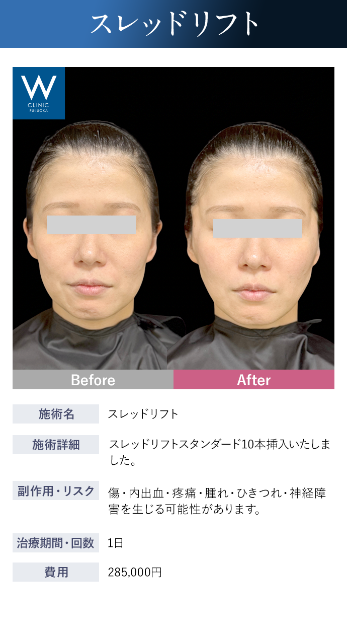 【スレッドリフト】施術詳細：スレッドリフトスタンダード10本挿入いたしました。｜副作用・リスク：傷・内出血・疼痛・腫れ・ひきつれ・神経障害を生じる可能性があります。｜治療期間・回数：1日｜費用：285,000円