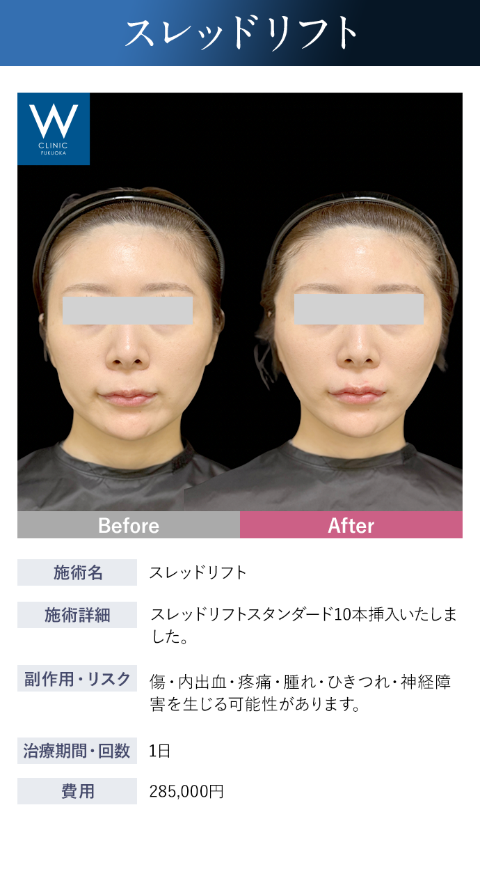 【スレッドリフト】施術詳細：スレッドリフトスタンダード10本挿入いたしました。｜副作用・リスク：傷・内出血・疼痛・腫れ・ひきつれ・神経障害を生じる可能性があります。｜治療期間・回数：1日｜費用：285,000円
