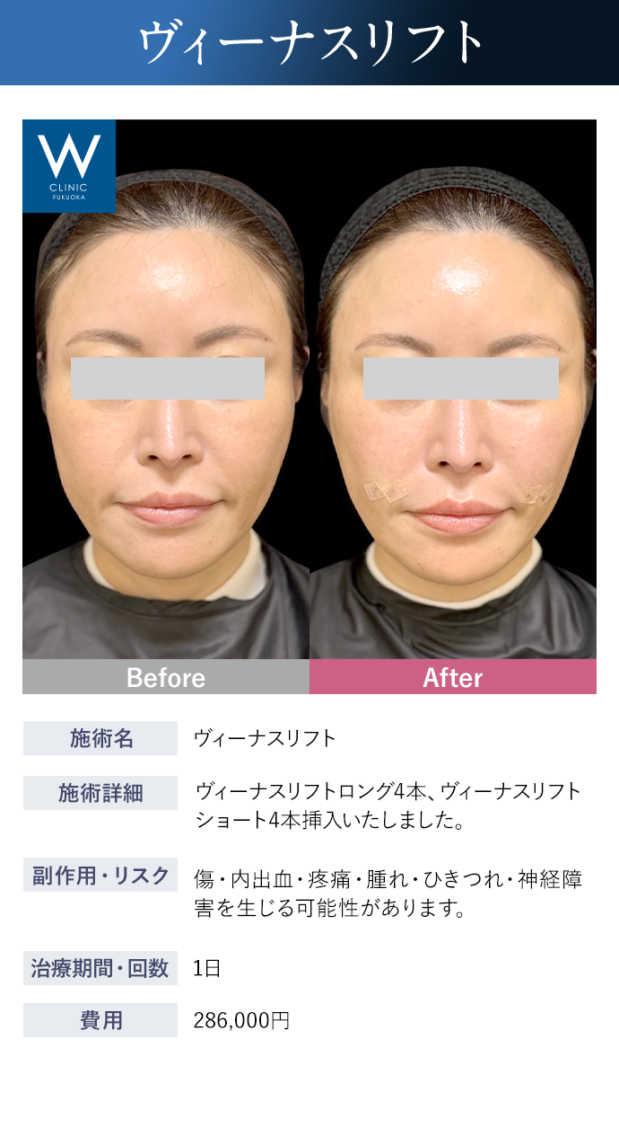 【スレッドリフト】施術詳細：ヴィーナスリフトロング4本、ヴィーナスリフトショート4本挿入いたしました。｜副作用・リスク：傷・内出血・疼痛・腫れ・ひきつれ・神経障害を生じる可能性があります。｜治療期間・回数：1日｜費用：286,000円