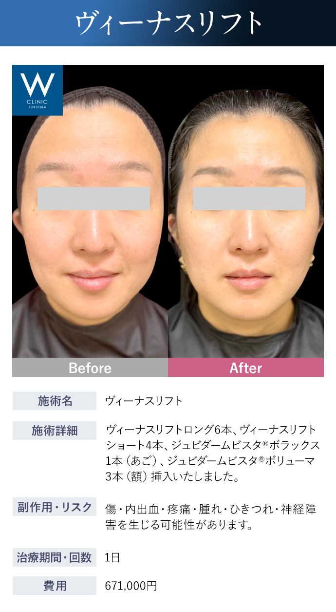 【スレッドリフト】施術詳細：ヴィーナスリフトロング6本、ヴィーナスリフトショート4本、ジュビダームビスタ®︎ボラックス1本（あご）、ジュビダームビスタ®︎ボリューマ3本（額）挿入いたしました。｜副作用・リスク：傷・内出血・疼痛・腫れ・ひきつれ・神経障害を生じる可能性があります。｜治療期間・回数：1日｜費用：671,000円