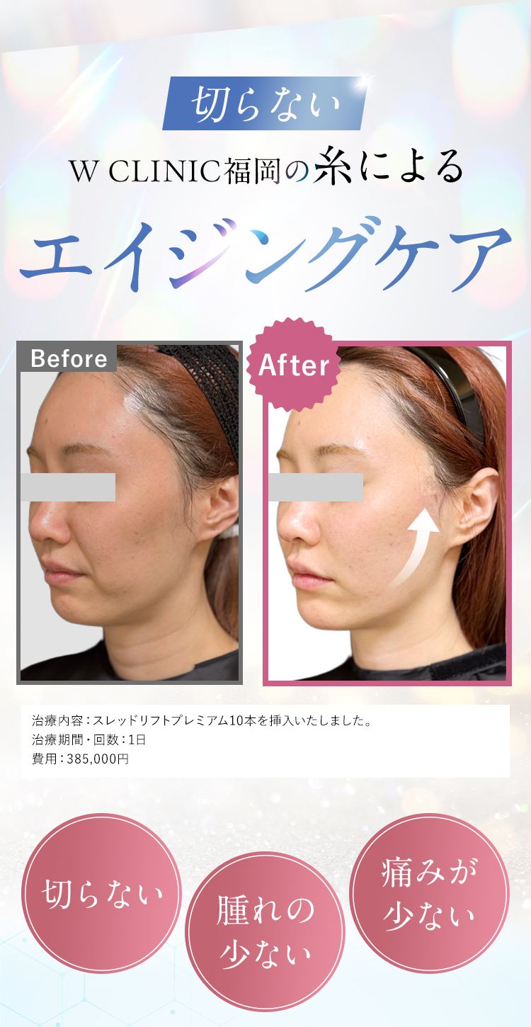 切らないW CLINIC福岡の糸によるエイジングケア｜治療内容：スレッドリフトプレミアム10本を挿入いたしました。治療期間・回数：1日費用：385,000円｜切らない/腫れの少ない/痛みが少ない