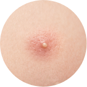 にきび/ニキビ跡