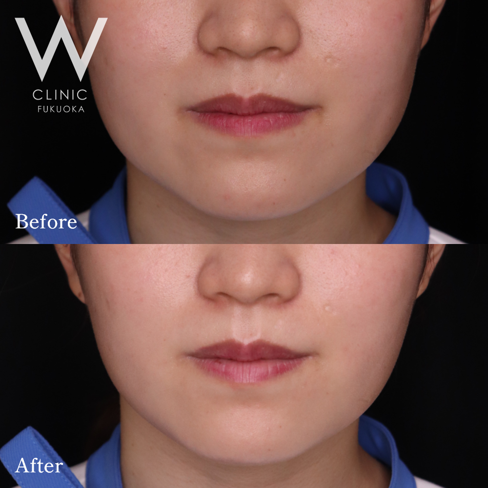 ボトックス注射(エラ)