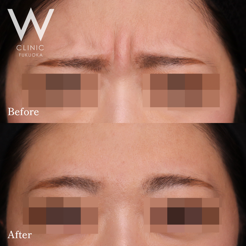 ボトックス注射(眉間)