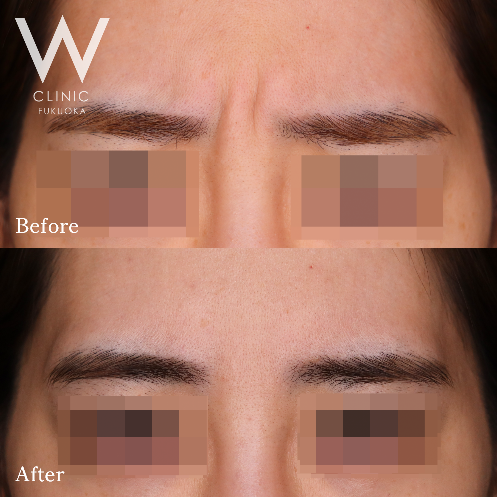 ボトックス注射(眉間)