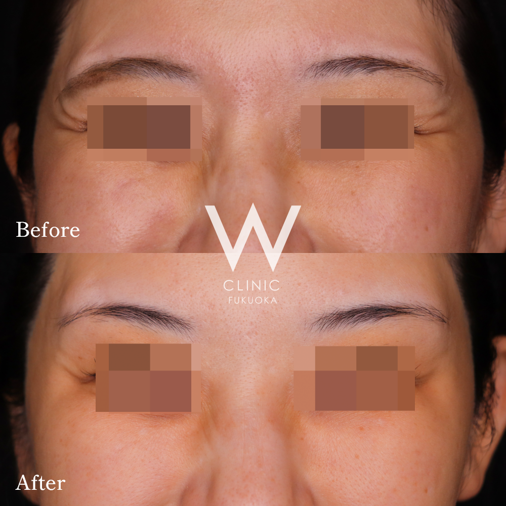 ボトックス注射(目尻)