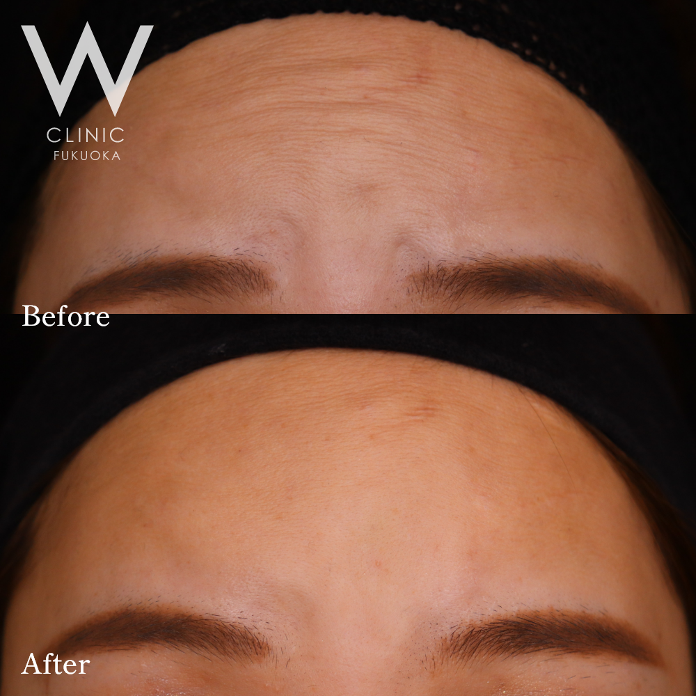 ボトックス注射(額)