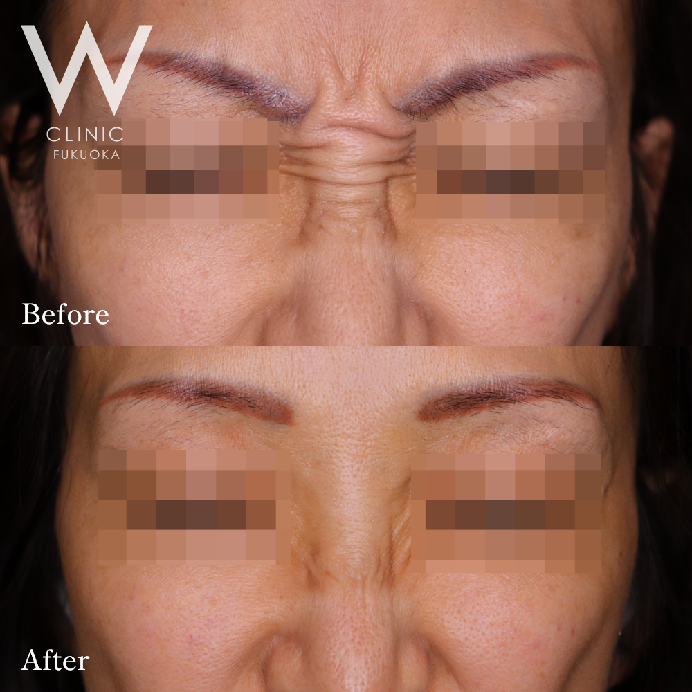 ボトックス注射(バニーライン)