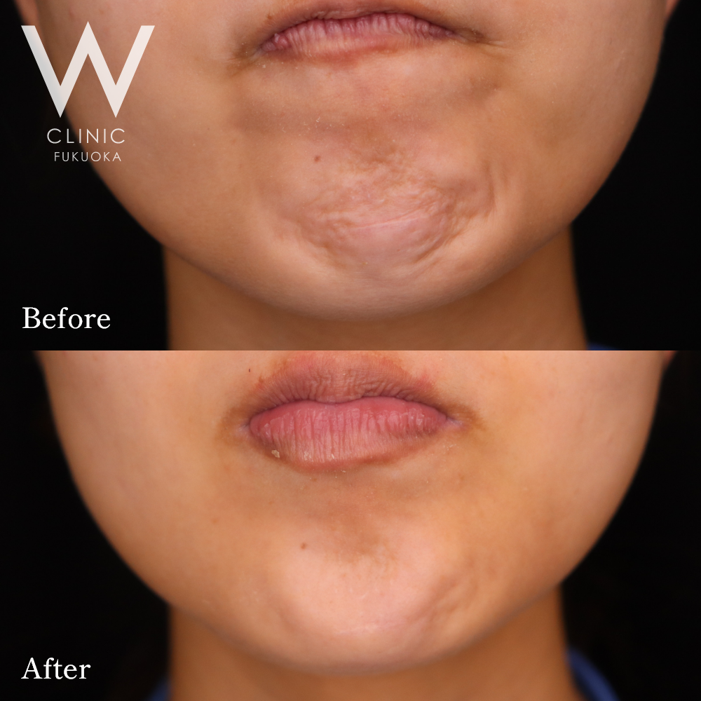 ボトックス注射(梅干しシワ)