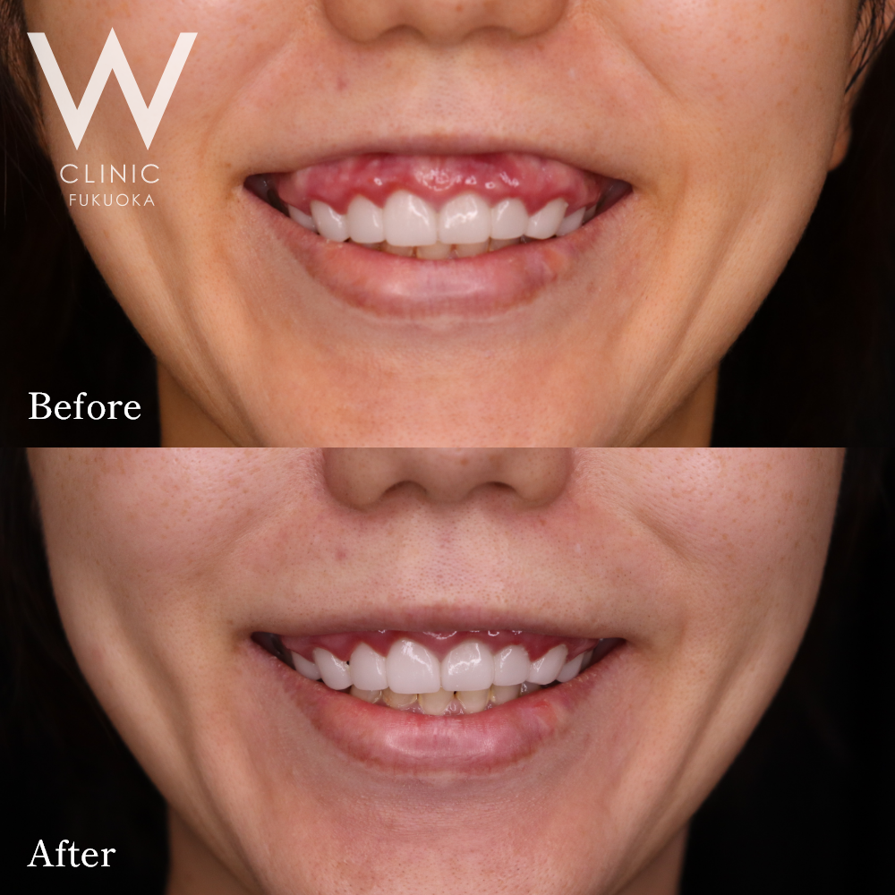 ボトックス注射(ガミースマイル)