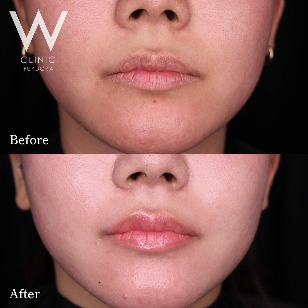 ボトックス注射(口角)