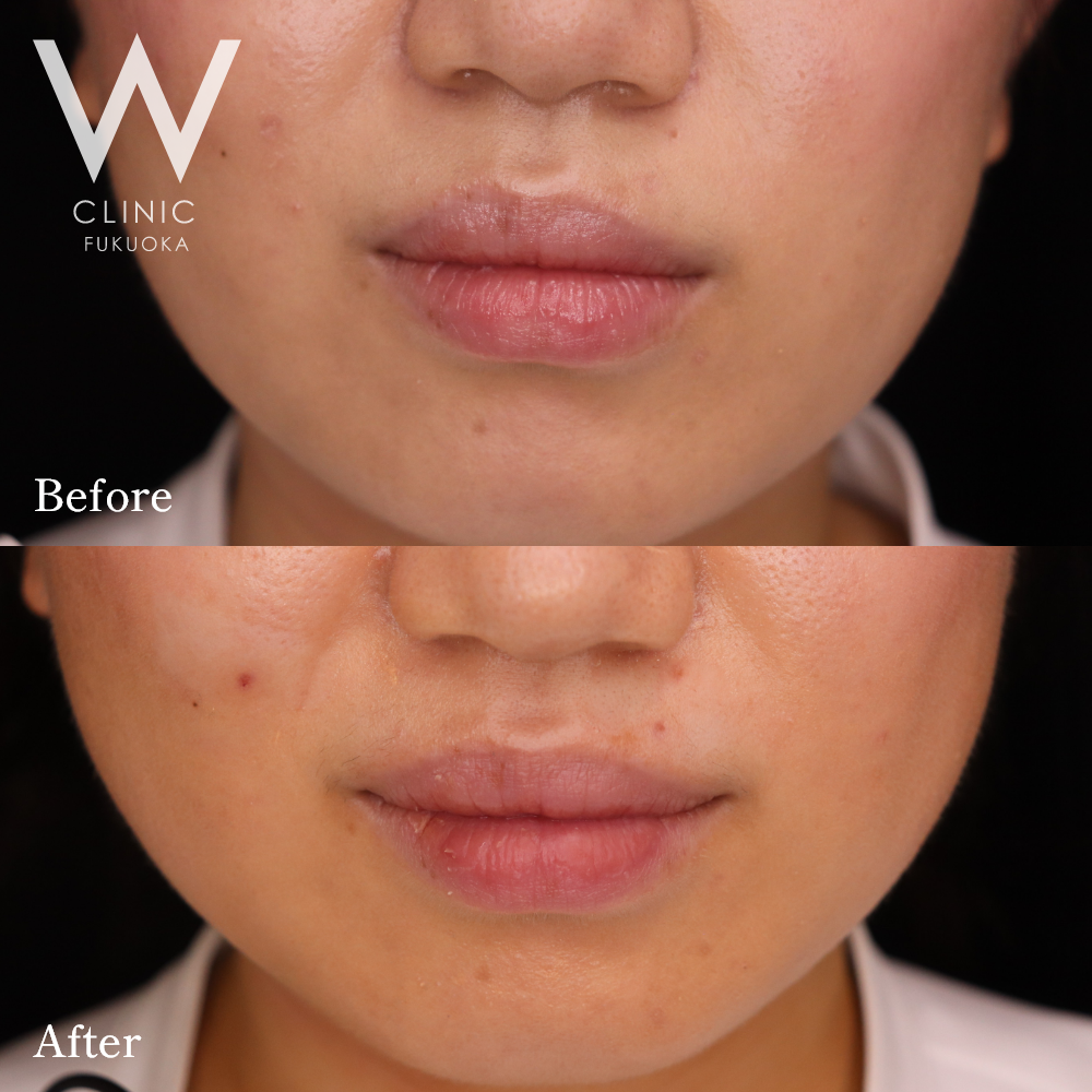 ボトックス注射(口角)