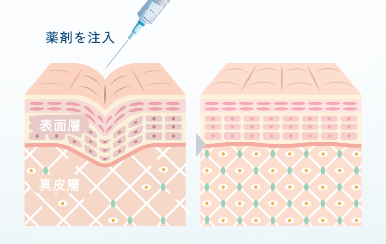肌育注射のメカニズム