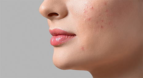 ニキビ跡の凹みの改善