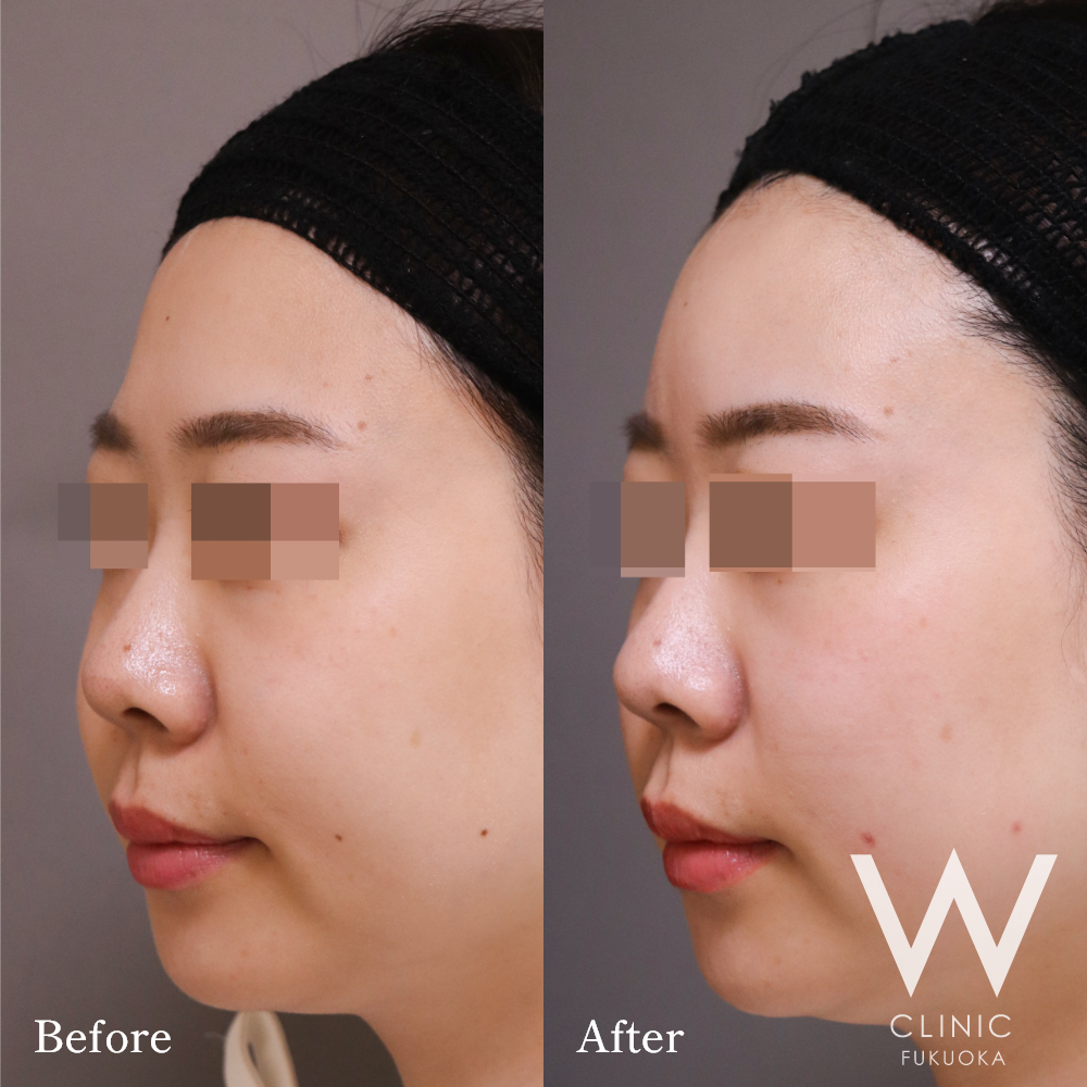 額ヒアルロン酸