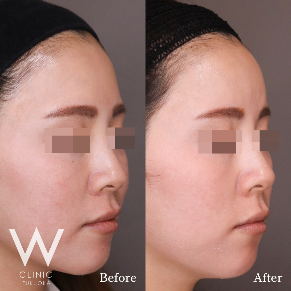 額ヒアルロン酸