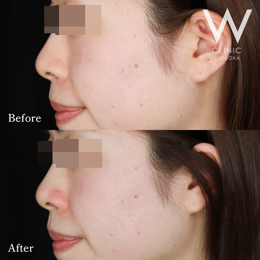 鼻ヒアルロン酸