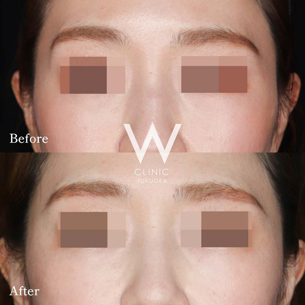 こめかみヒアルロン酸