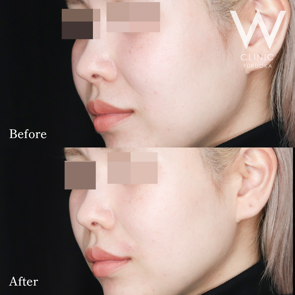 ほうれい線ヒアルロン酸