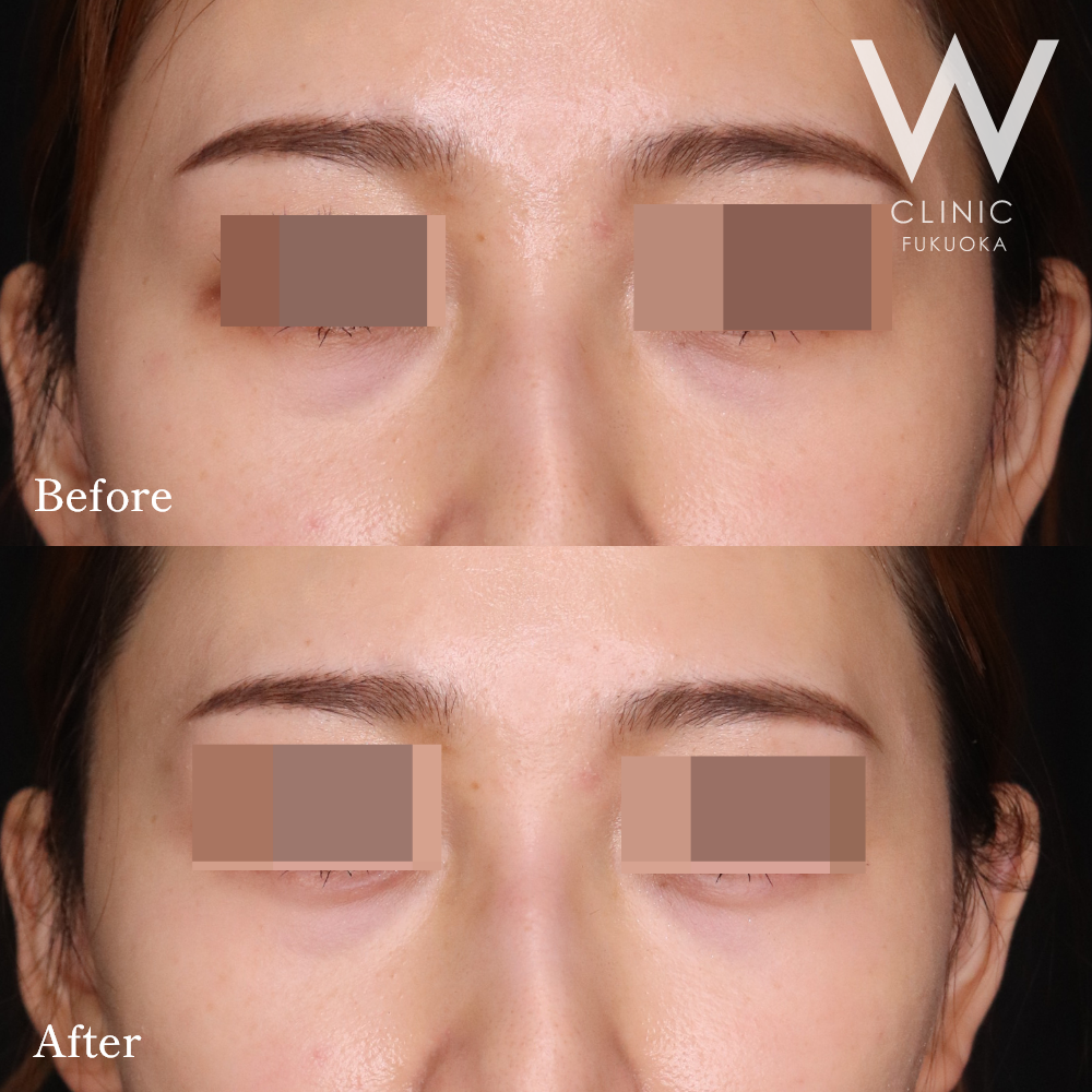 涙袋ヒアルロン酸