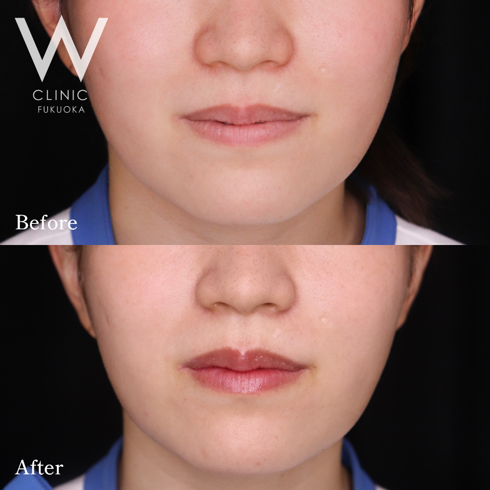 口唇ヒアルロン酸