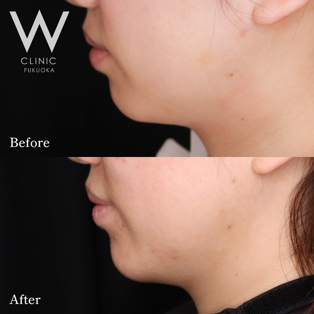 あごヒアルロン酸