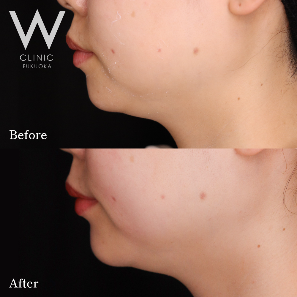 あごヒアルロン酸