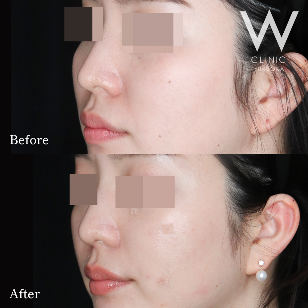 鼻翼基部ヒアルロン酸