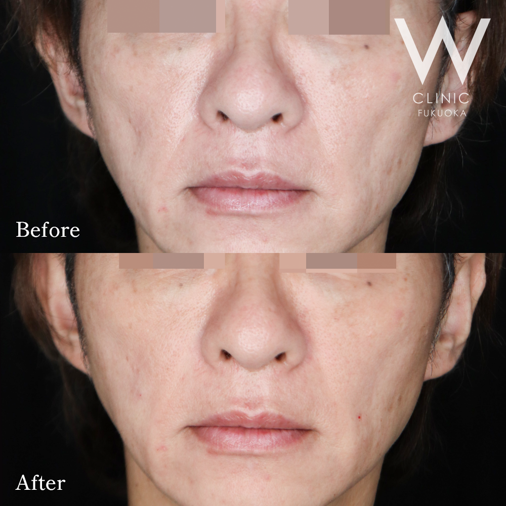 頬コケヒアルロン酸