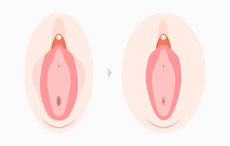 小陰唇縮小術とは