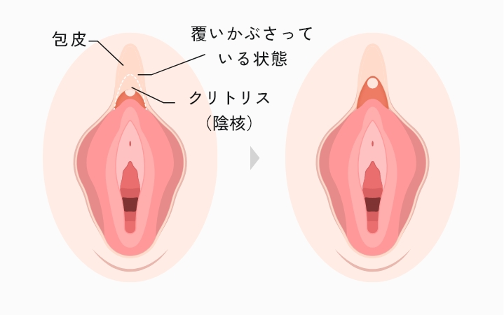 クリトリス包茎